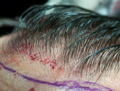 Hair Transplant and Laser Surgery: Cosmetic Surgery Claims and Injuries